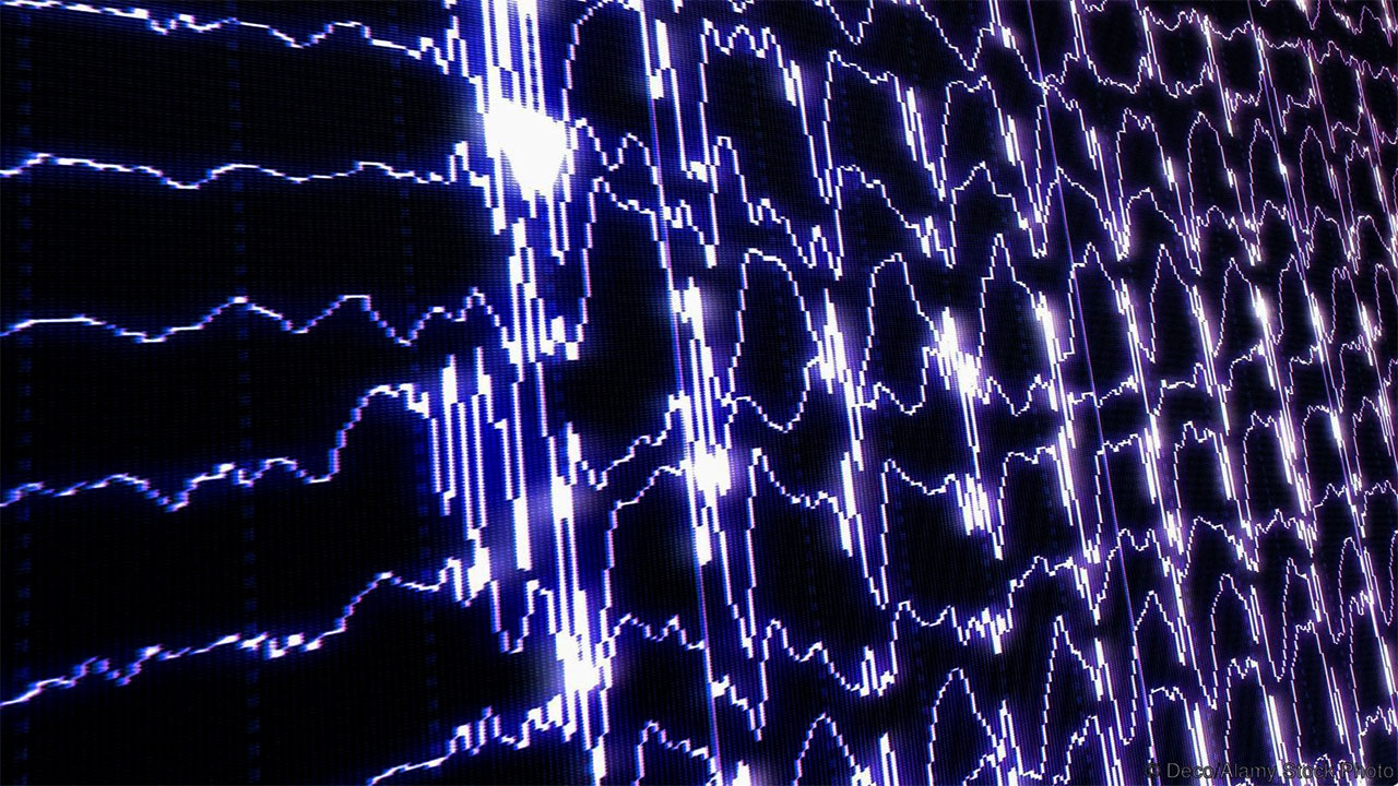 Obsesif Kompulsif Bozuklukta Transkranial Manyetik Stimülasyon ve Tedaviye Cevabı Öngörmede EEG Kullanımı