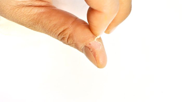 Deri yolma bozukluğu